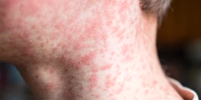 Measles reappears in Hidalgo after 21 years of absence