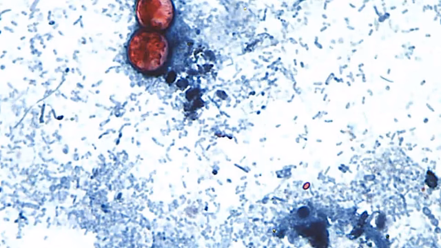 Cyclospora-Ausbruch im Zusammenhang mit Taco-Bell-Salat in fünf Bundesstaaten